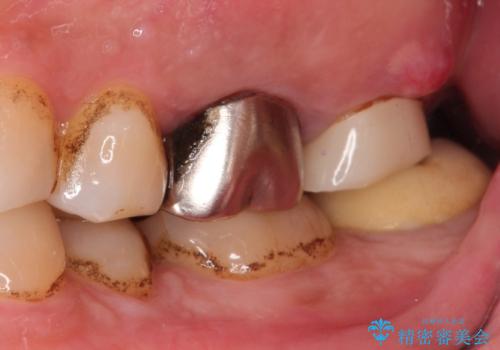 【歯牙破折】インプラントによる咬合回復の治療前