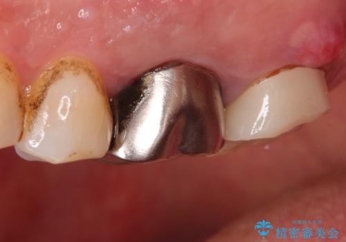 【歯牙破折】インプラントによる咬合回復の治療前