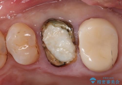 【歯牙破折】インプラントによる咬合回復の治療中