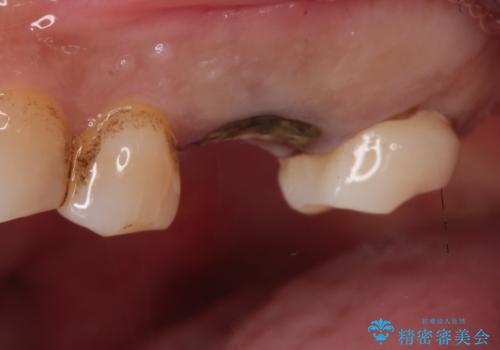 【歯牙破折】インプラントによる咬合回復の治療中