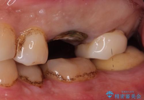 【歯牙破折】インプラントによる咬合回復の治療中