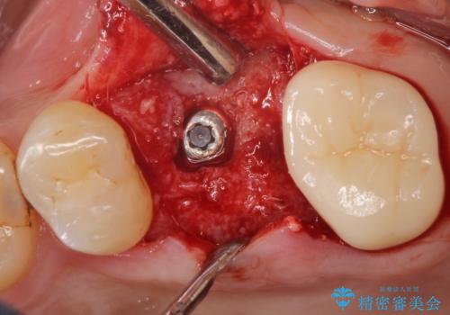 【歯牙破折】インプラントによる咬合回復の治療中
