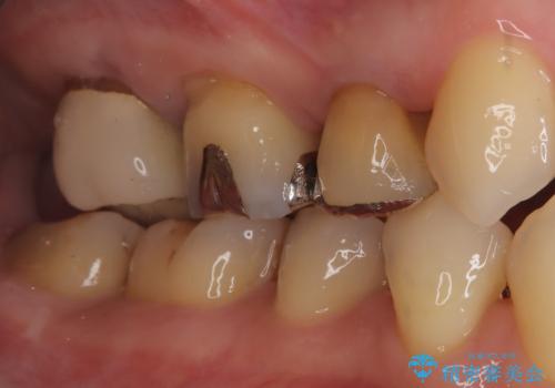 【オールセラミッククラウン】メタルフリー治療の治療前