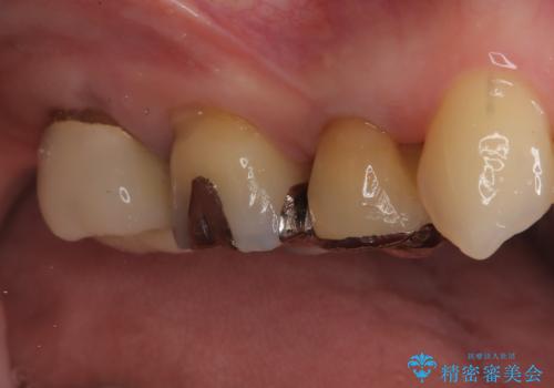 【オールセラミッククラウン】メタルフリー治療の治療前