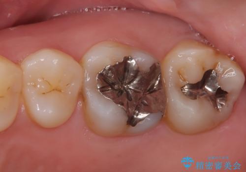 【セラミッククラウン】メタルフリー治療の治療前