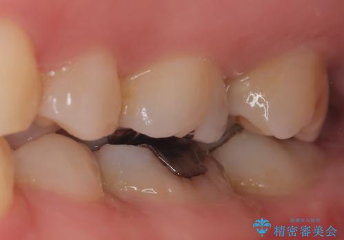 【セラミッククラウン】メタルフリー治療の治療前
