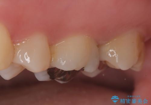 【セラミッククラウン】メタルフリー治療の治療前