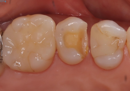 【セラミックインレー】昔治療した詰め物が外れた。の治療前