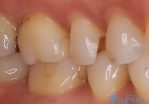 【セラミックインレー】昔治療した詰め物が外れた。の治療前