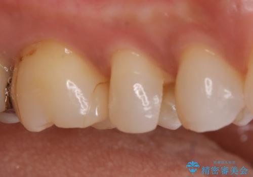 【セラミックインレー】昔治療した詰め物が外れた。の治療前
