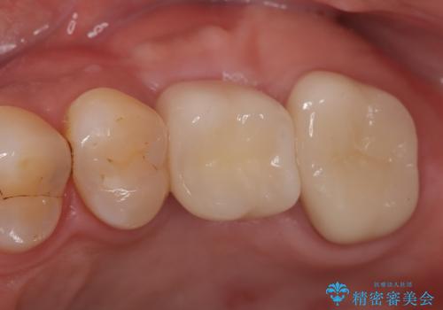 【歯牙破折】インプラントによる咬合回復の症例 治療後