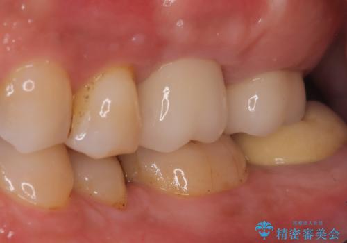【歯牙破折】インプラントによる咬合回復の治療後