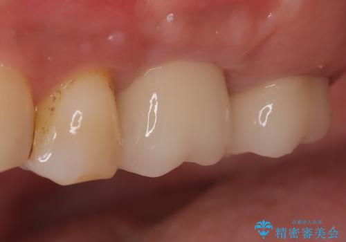 【歯牙破折】インプラントによる咬合回復の治療後