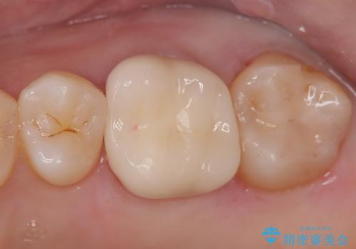 【セラミッククラウン】メタルフリー治療