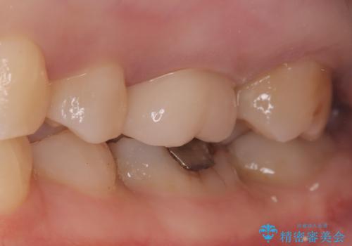 【セラミッククラウン】メタルフリー治療の治療後