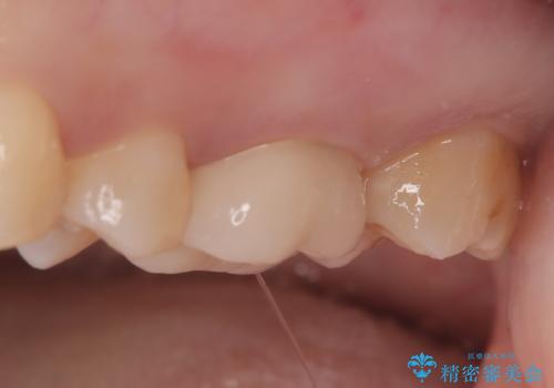 【セラミッククラウン】メタルフリー治療の治療後