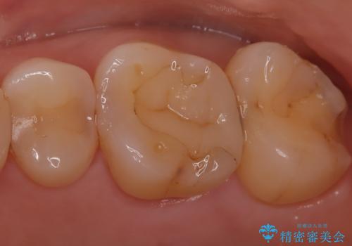 【セラミックインレー】適合の良いセラミックインレーを入れたい。の治療前