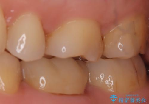 【セラミックインレー】適合の良いセラミックインレーを入れたい。の治療前