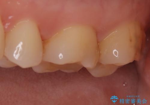 【セラミックインレー】適合の良いセラミックインレーを入れたい。の治療前