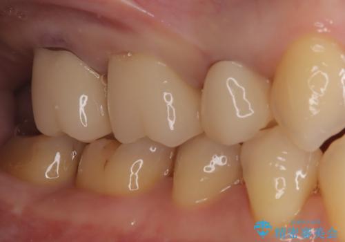 【オールセラミッククラウン】メタルフリー治療の治療後
