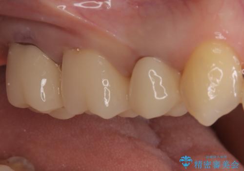【オールセラミッククラウン】メタルフリー治療の治療後