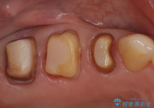 【オールセラミッククラウン】メタルフリー治療の治療中