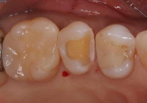 【セラミックインレー】昔治療した詰め物が外れた。の治療中