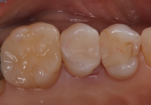 【セラミックインレー】昔治療した詰め物が外れた。の治療後