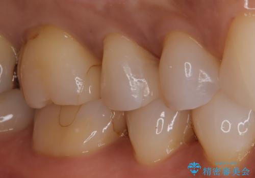【セラミックインレー】昔治療した詰め物が外れた。の治療後