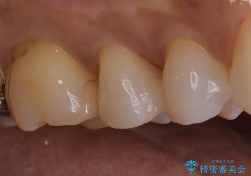【セラミックインレー】昔治療した詰め物が外れた。の治療後
