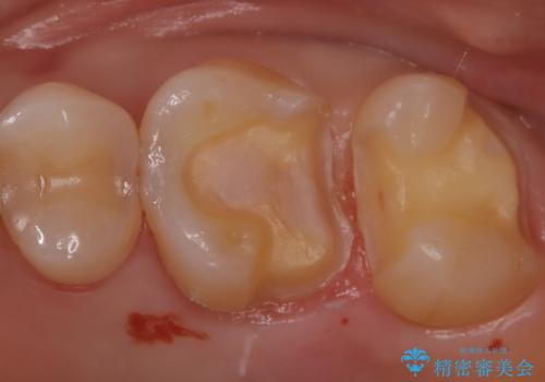 【セラミックインレー】適合の良いセラミックインレーを入れたい。の治療中