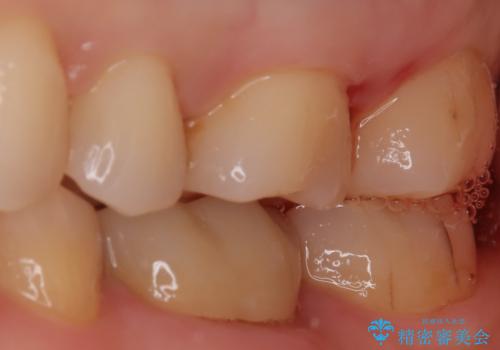 【セラミックインレー】適合の良いセラミックインレーを入れたい。の治療後