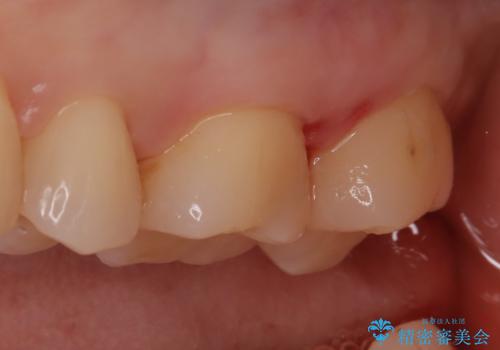 【セラミックインレー】適合の良いセラミックインレーを入れたい。の治療後