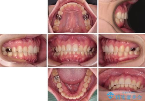 インビザラインによる矯正治療と奥歯のインプラント治療の治療後