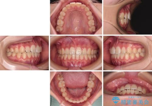インビザラインは使える自信がない ワイヤー装置にて矯正治療の治療後