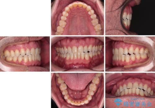 前歯でものを噛みきりたい 目立たない装置でのワイヤー矯正の治療後