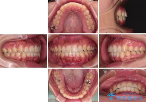 【モニター】カリエール・ディスタライザーを併用した八重歯のインビザライン矯正 の治療後