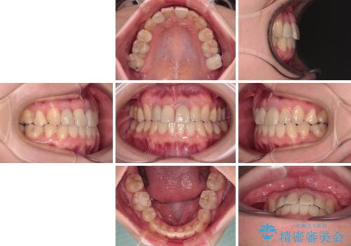 虫歯治療ついでに歯並びの後戻りを改善　インビザラインによる矯正治療の治療後