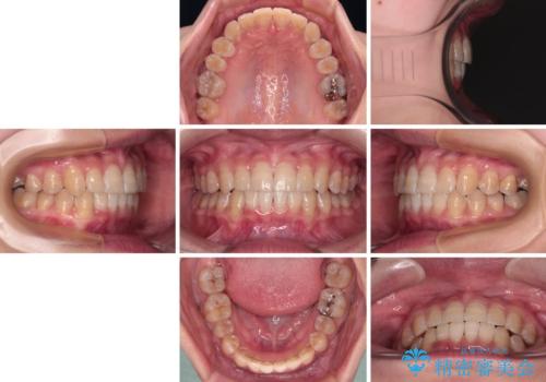 【モニター】下顎前歯のデコボコをインビザラインできれいにの治療後