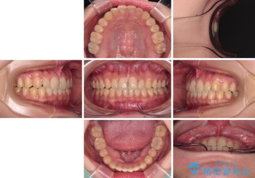 治療途中の奥歯と矯正治療の後戻り インビザライン・ライトによる矯正治療の治療後