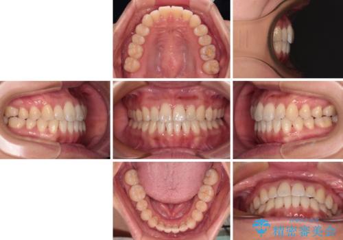 【モニター】前歯のデコボコをインビザラインで改善の治療後