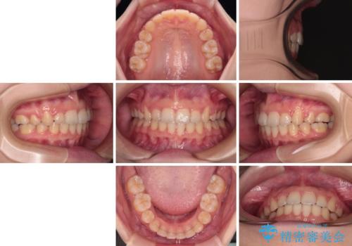 口が閉じられない　ワイヤー装置での抜歯矯正の治療後