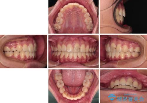膨らんだ口元 ワイヤー装置での抜歯矯正の治療後