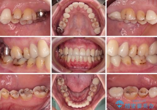 むし歯だらけの前歯をオールセラミッククラウンできれいにの治療後