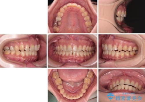 【モニター】飛び出た前歯を整えたい ワイヤー矯正治療の治療後