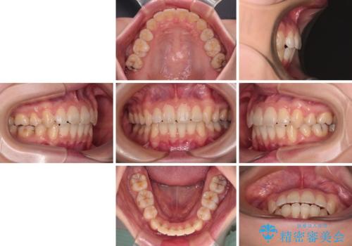 【モニター】口が閉じにくい 抜歯矯正で口元を引っ込めるの治療後