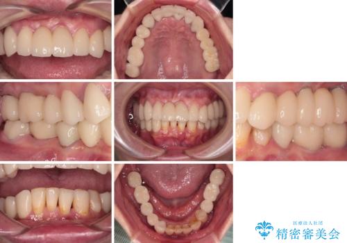 放置したインプラントとインビザライン 全顎リカバリー治療の治療後