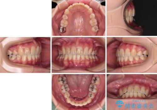 デコボコと深い咬み合わせ ワイヤー装置での抜歯矯正の治療後