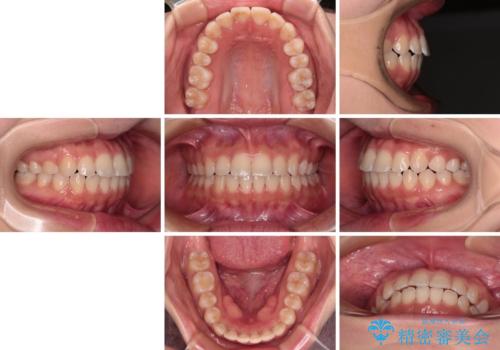 【モニター】短期間で終わりたい ワイヤー装置での非抜歯矯正の治療後