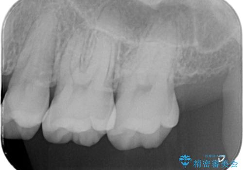 歯周病治療【オープンフラップ】の治療後